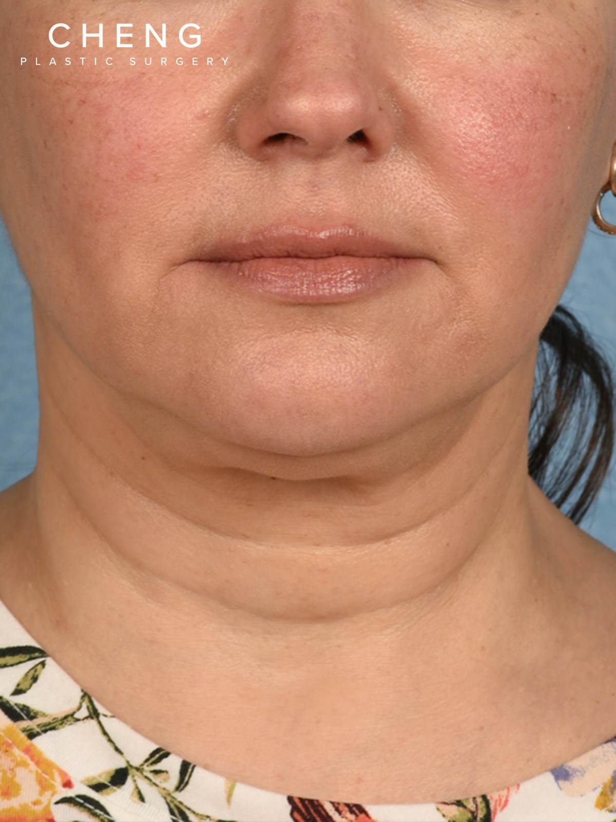 Hidden Patients Before & After Gallery - Patient 294314 - Image 1