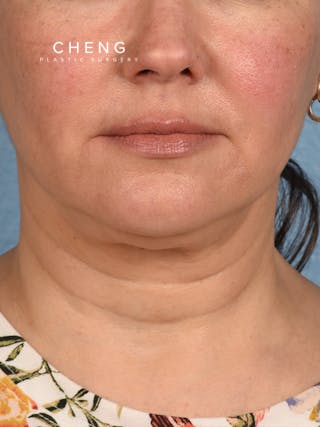 Hidden Patients Before & After Gallery - Patient 294314 - Image 1