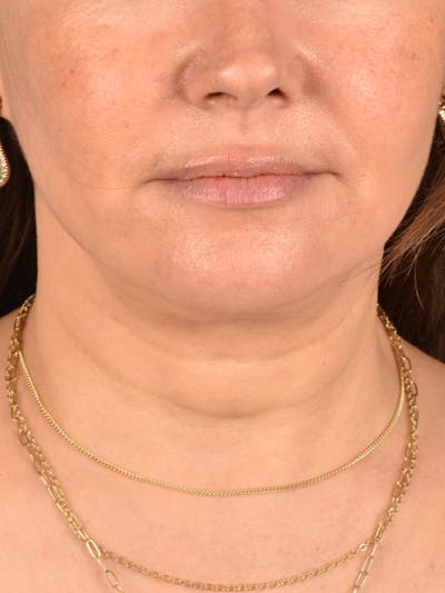 Neck Lift Before & After Gallery - Patient 382090 - Image 2