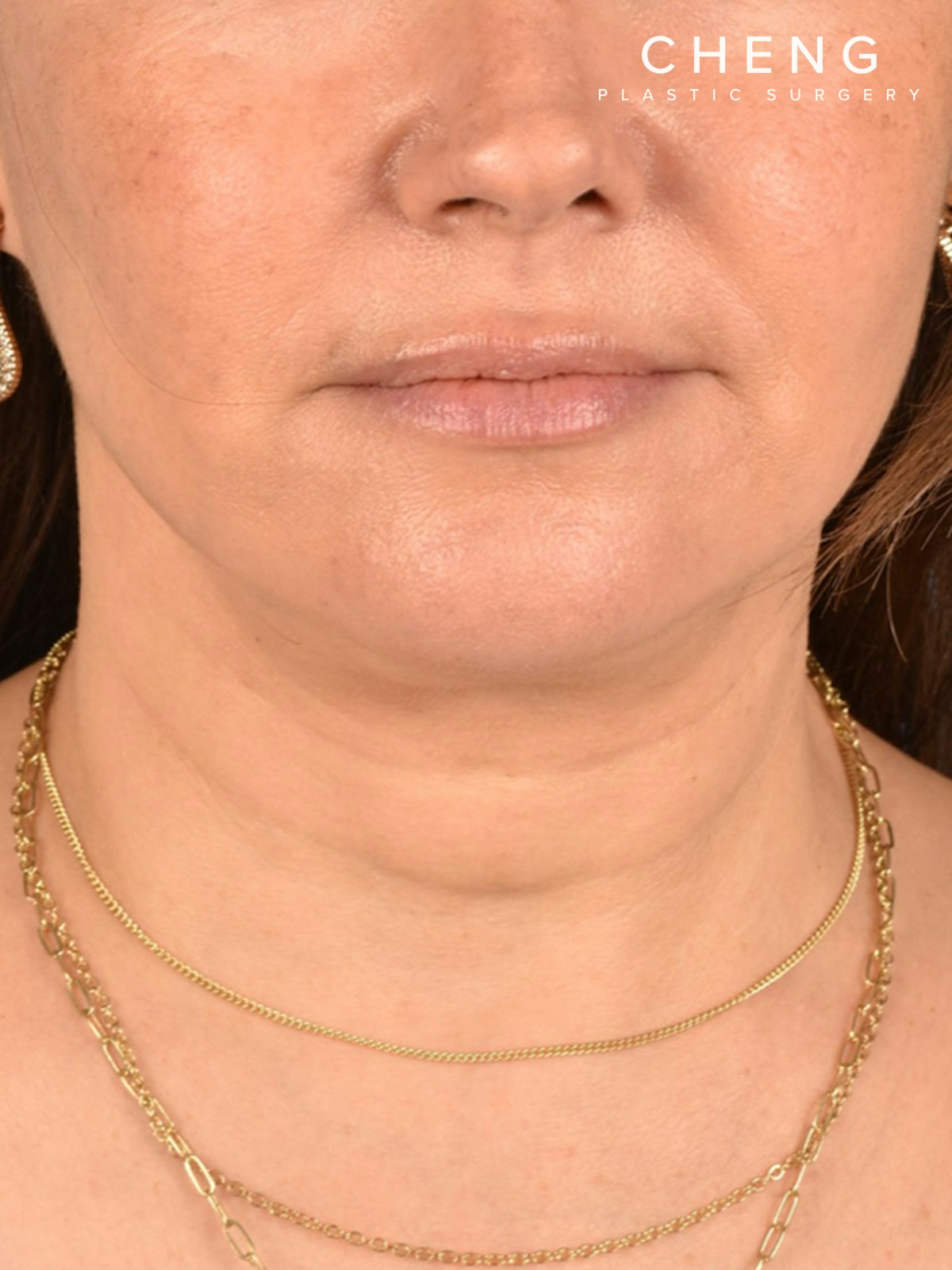 Hidden Patients Before & After Gallery - Patient 294314 - Image 2