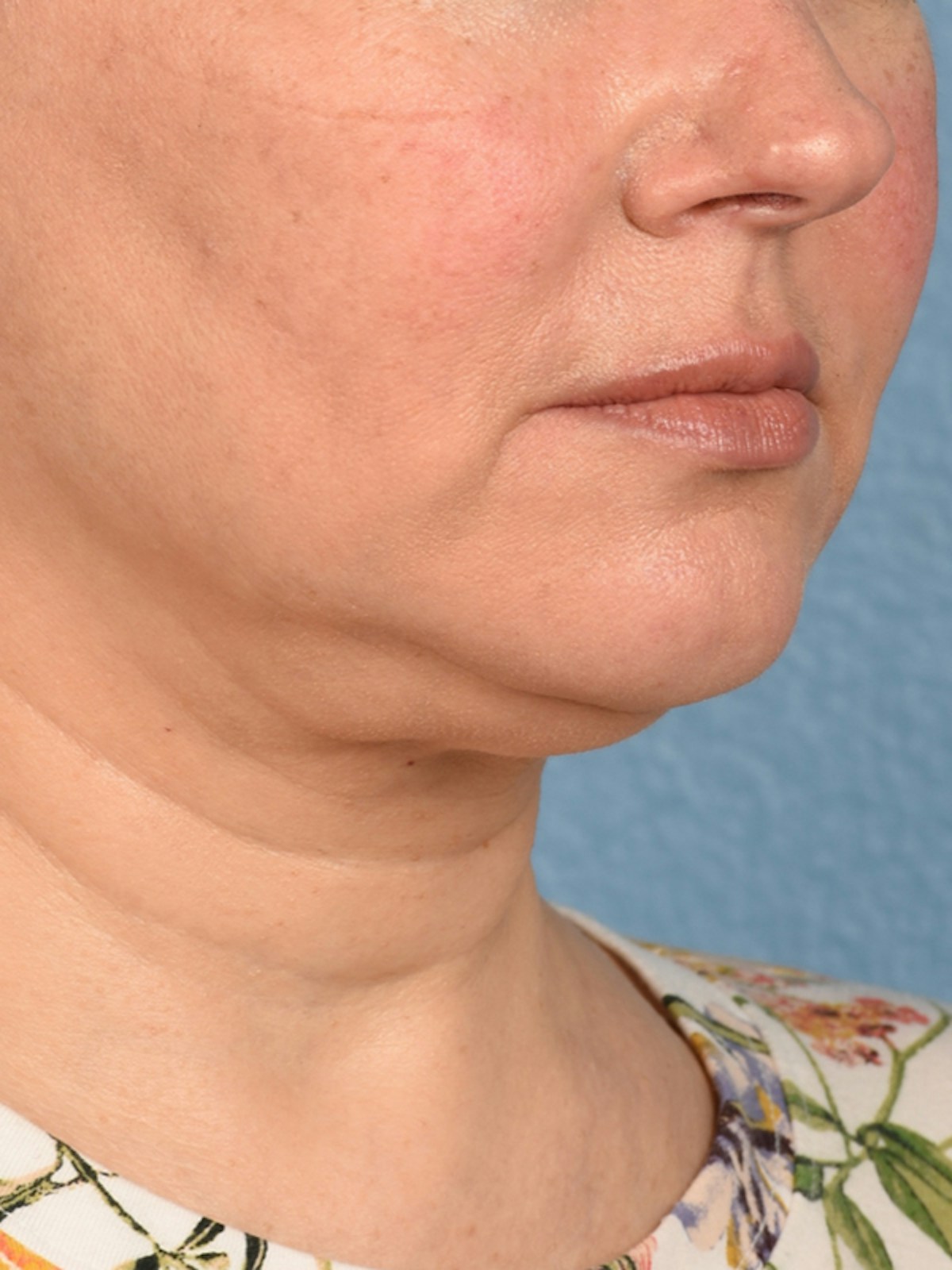 Facelift Before & After Gallery - Patient 545599 - Image 3