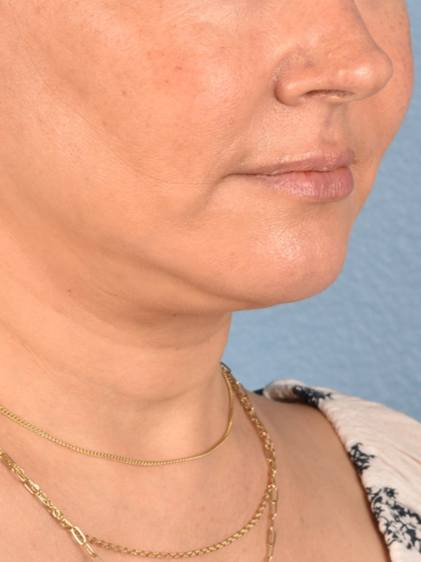 Hidden Patients Before & After Gallery - Patient 294314 - Image 4