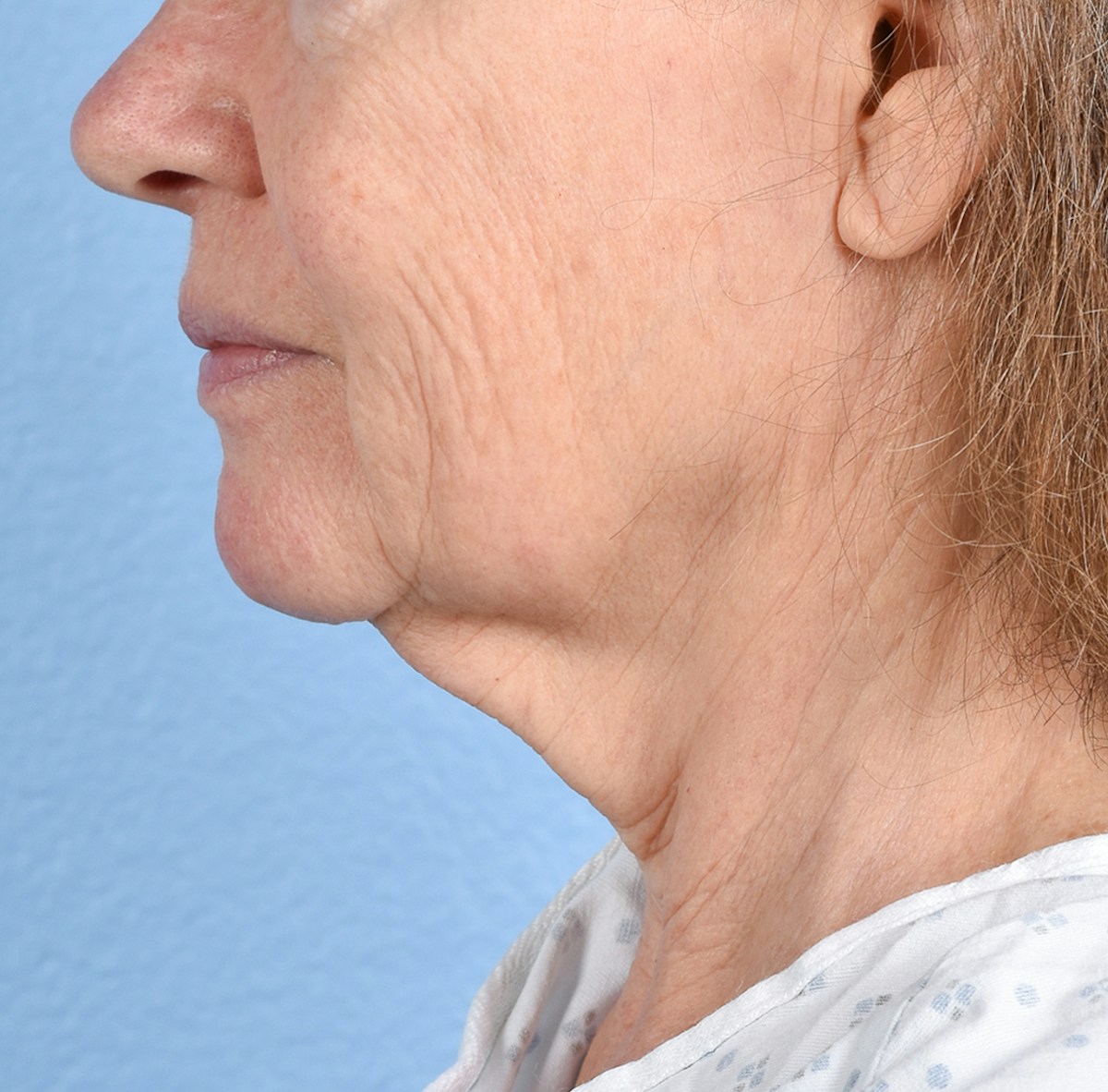 Facelift Before & After Gallery - Patient 248699 - Image 1