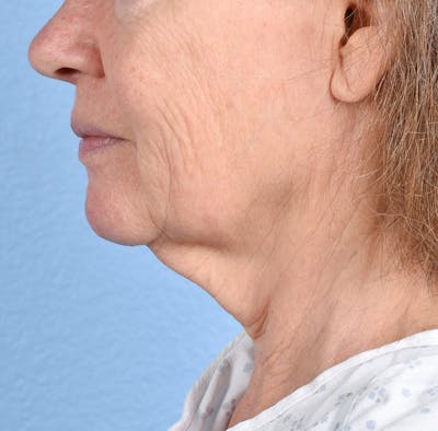 Neck Lift Before & After Gallery - Patient 328488 - Image 1