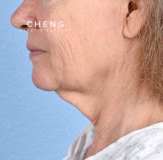 Hidden Patients Before & After Gallery - Patient 222540 - Image 1