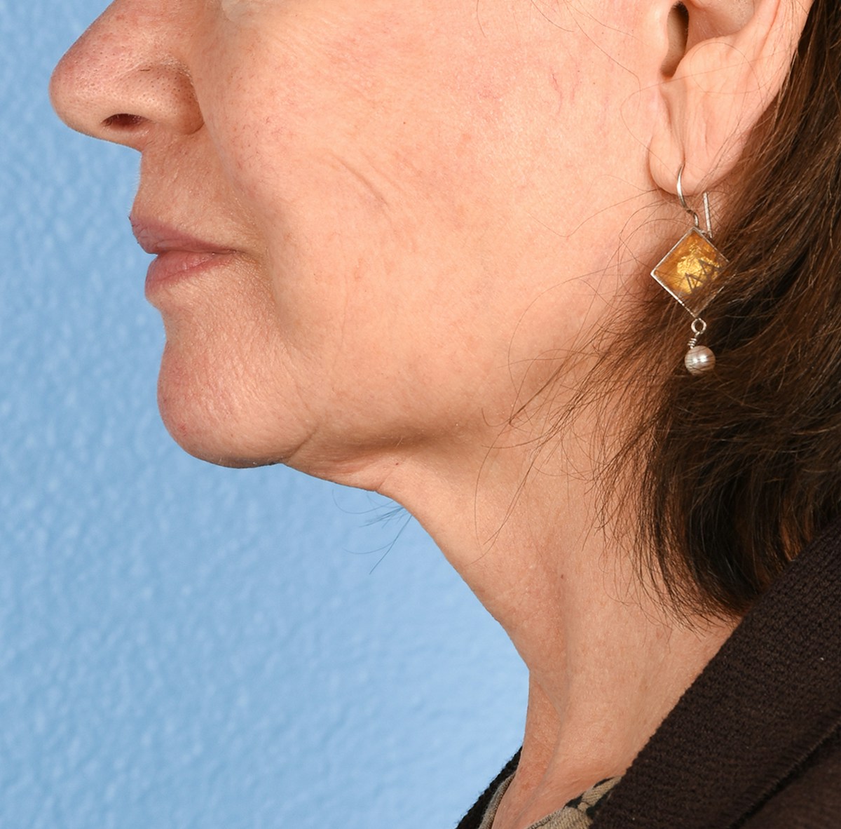 Facelift Before & After Gallery - Patient 248699 - Image 2