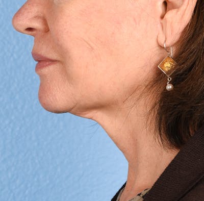 Neck Lift Before & After Gallery - Patient 328488 - Image 2