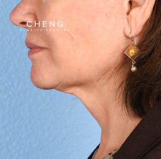 Hidden Patients Before & After Gallery - Patient 222540 - Image 2