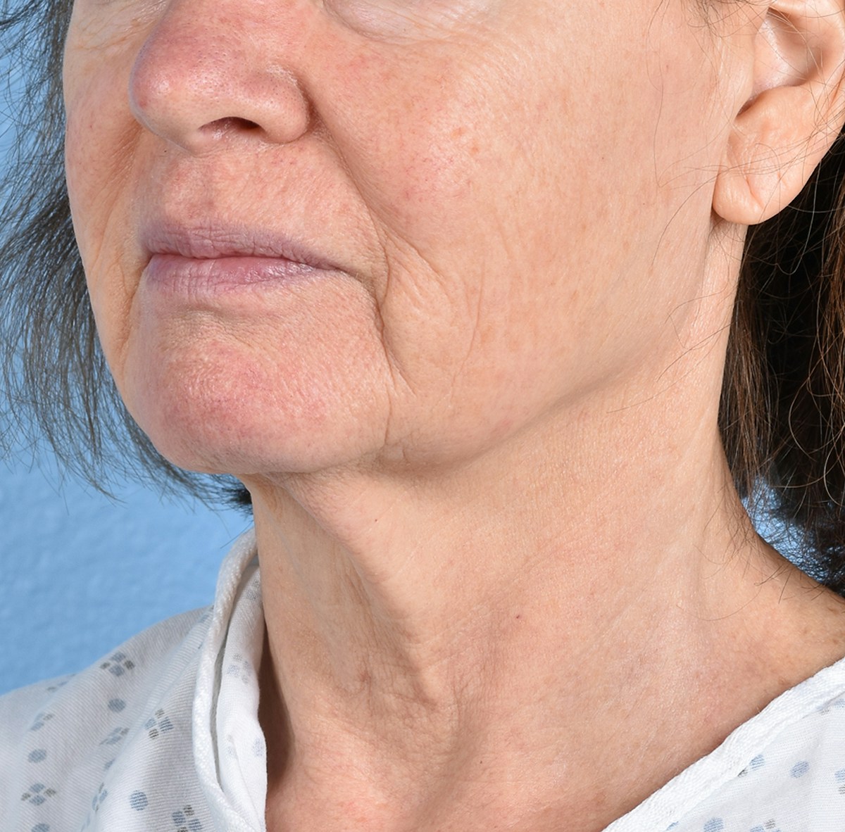 Facelift Before & After Gallery - Patient 248699 - Image 3