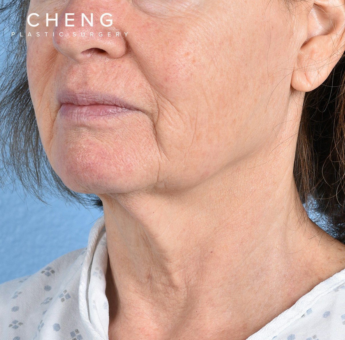 Hidden Patients Before & After Gallery - Patient 222540 - Image 3