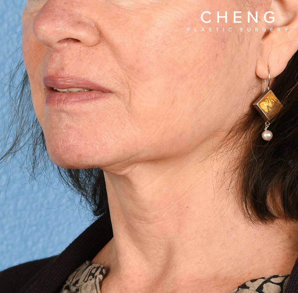 Hidden Patients Before & After Gallery - Patient 222540 - Image 4