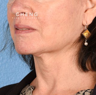 Hidden Patients Before & After Gallery - Patient 222540 - Image 4