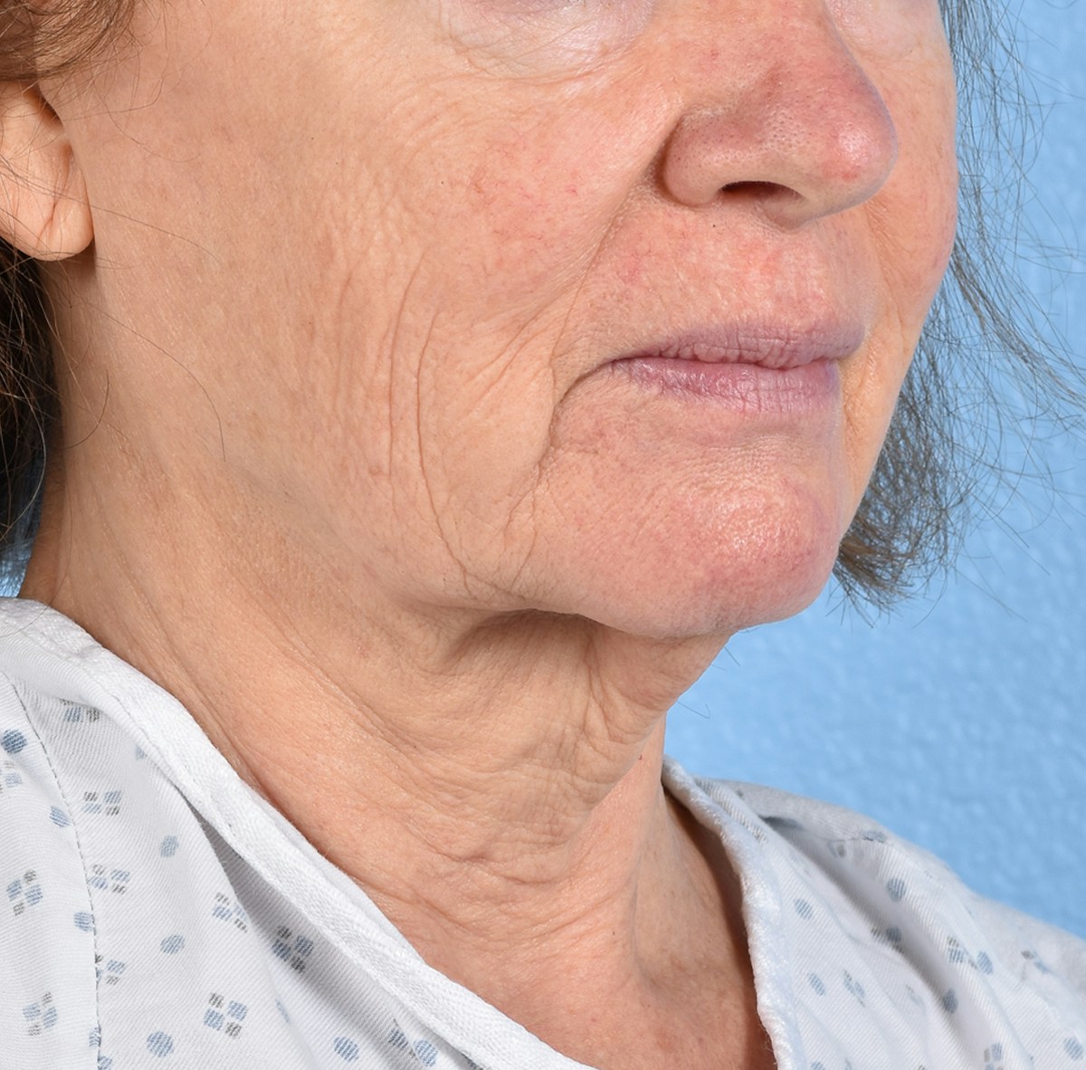 Facelift Before & After Gallery - Patient 248699 - Image 5