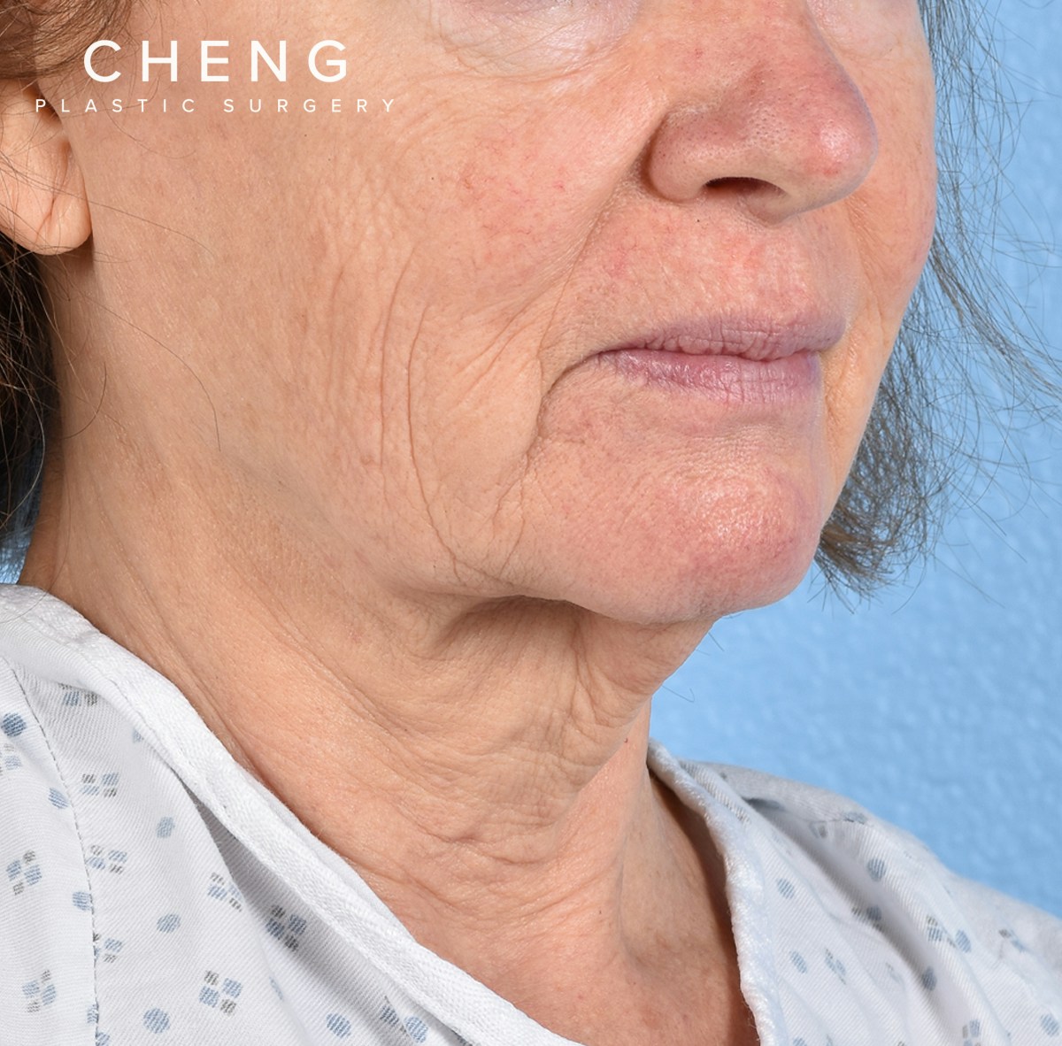 Hidden Patients Before & After Gallery - Patient 222540 - Image 5