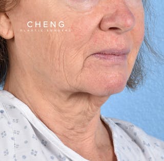 Hidden Patients Before & After Gallery - Patient 222540 - Image 5