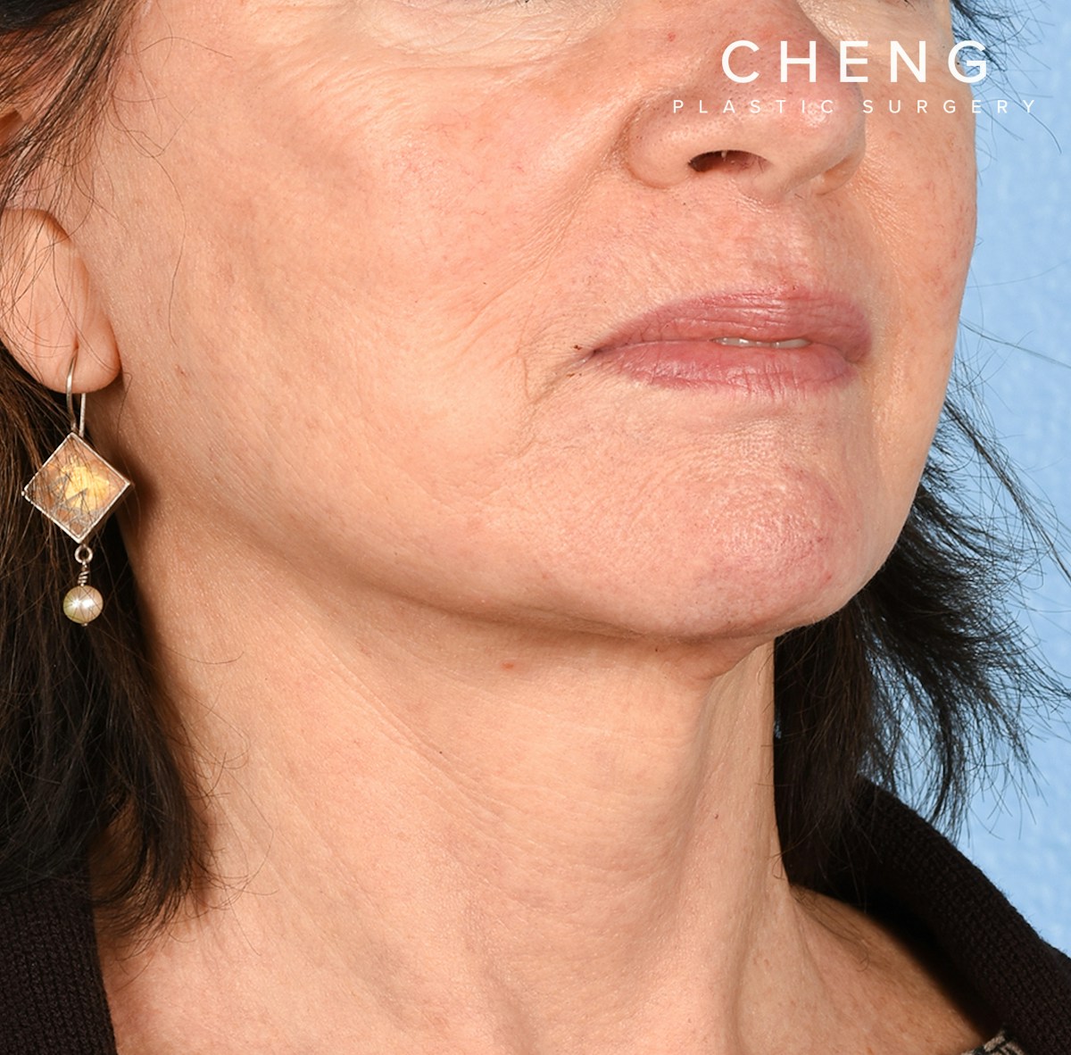 Hidden Patients Before & After Gallery - Patient 222540 - Image 6