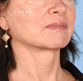 Hidden Patients Before & After Gallery - Patient 222540 - Image 6