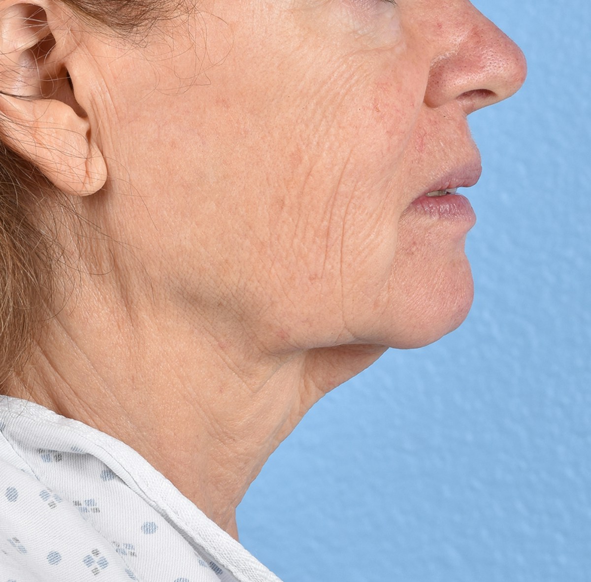 Facelift Before & After Gallery - Patient 248699 - Image 7