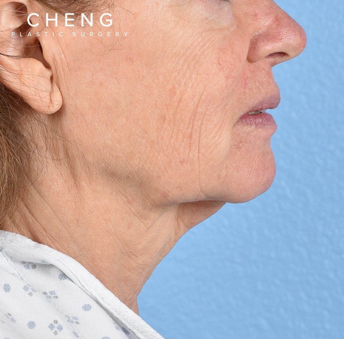 Hidden Patients Before & After Gallery - Patient 222540 - Image 7