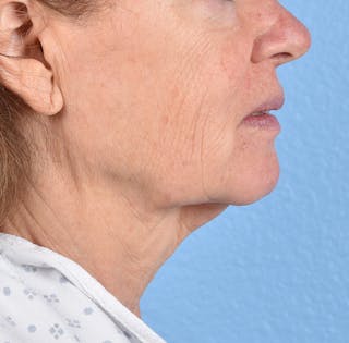 Hidden Patients Before & After Gallery - Patient 222540 - Image 7