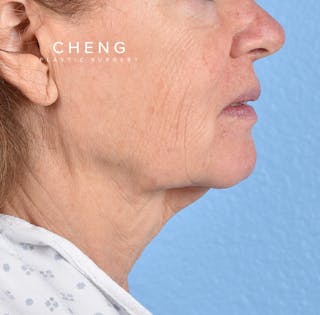 Hidden Patients Before & After Gallery - Patient 222540 - Image 7