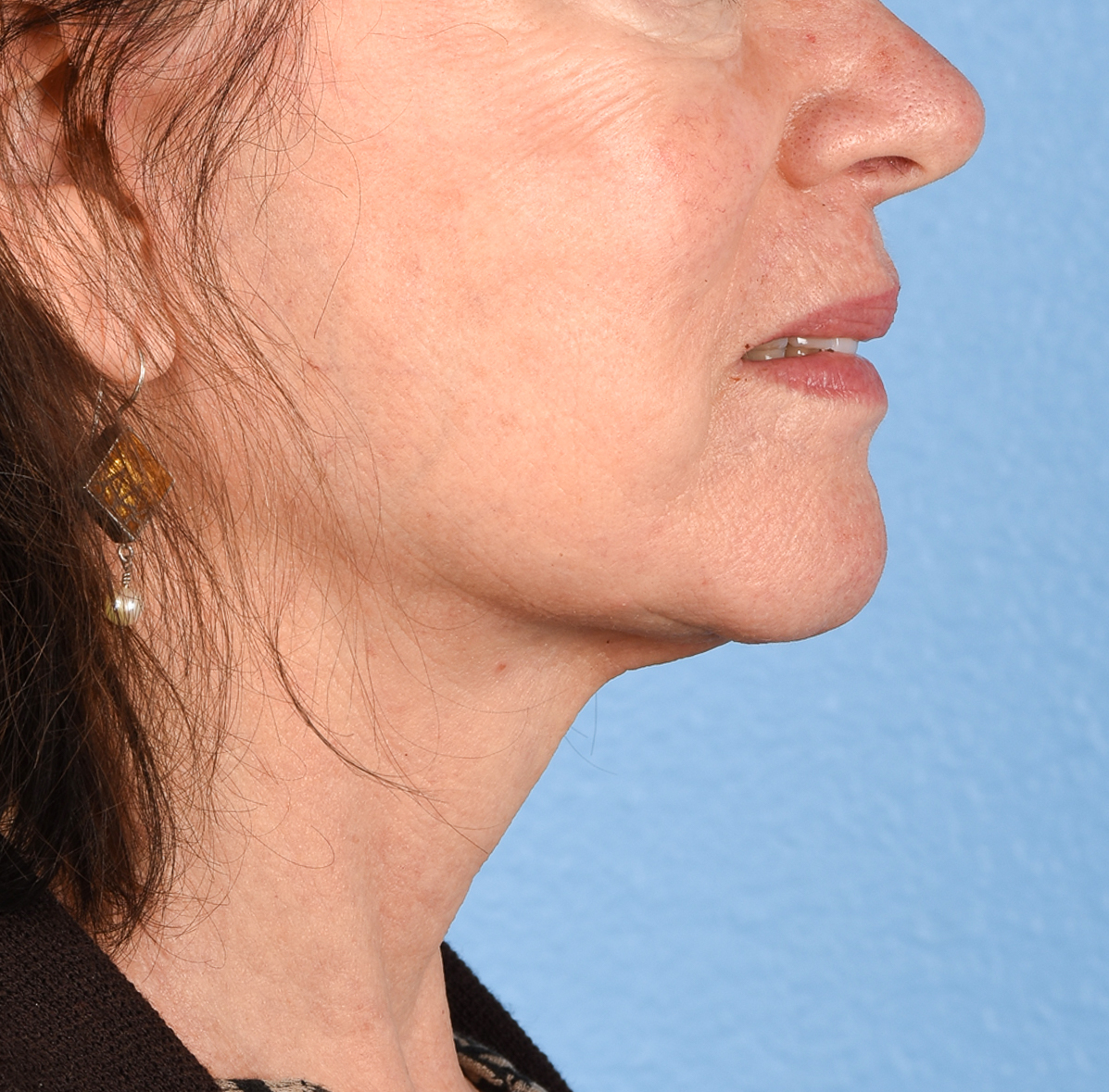 Hidden Patients Before & After Gallery - Patient 222540 - Image 8