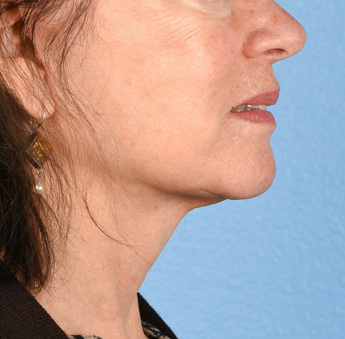 Facelift Before & After Gallery - Patient 248699 - Image 8