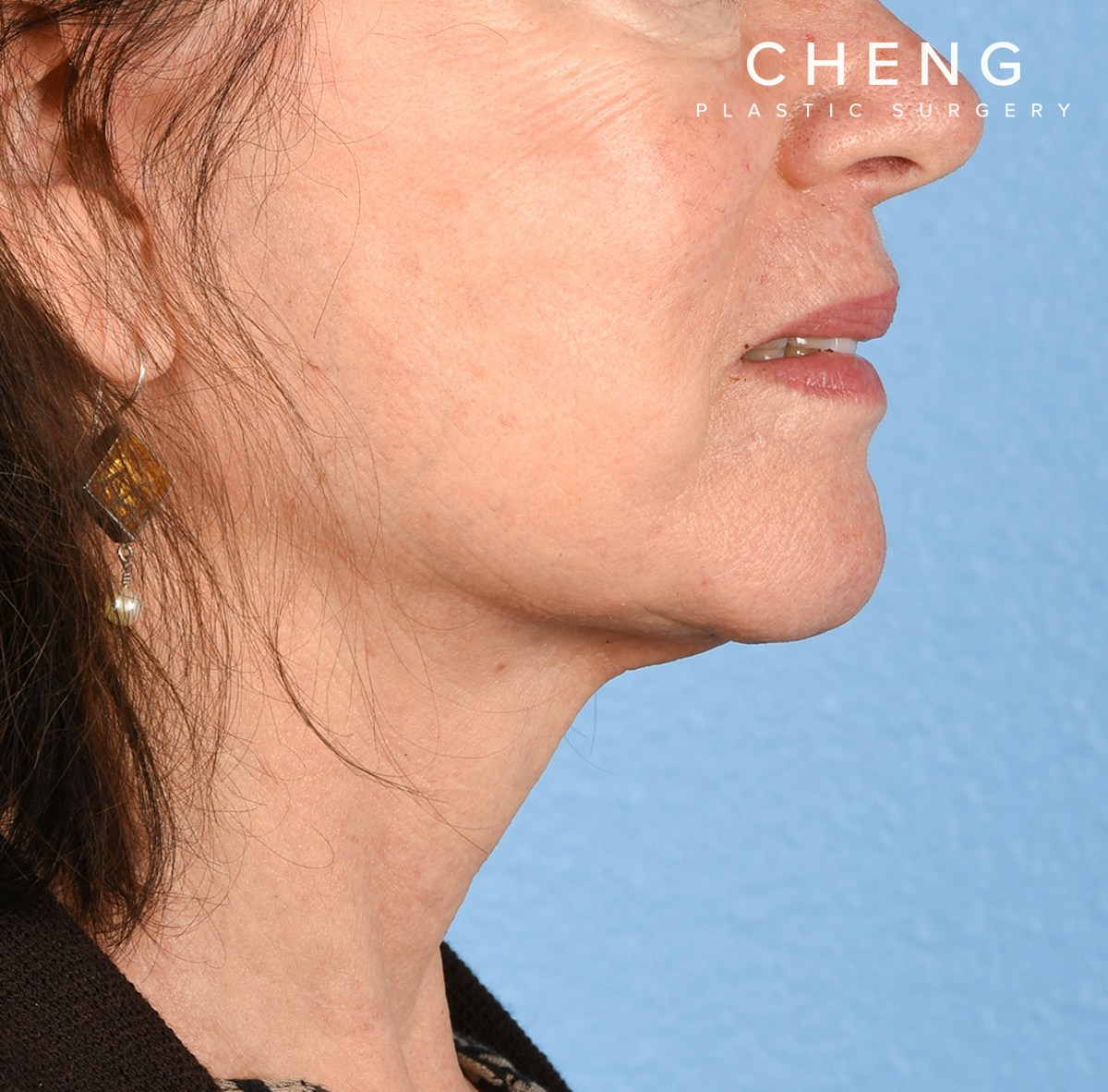 Hidden Patients Before & After Gallery - Patient 222540 - Image 8