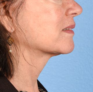 Hidden Patients Before & After Gallery - Patient 222540 - Image 8