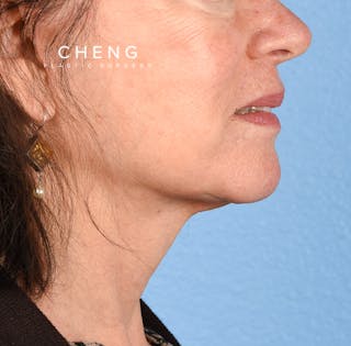 Hidden Patients Before & After Gallery - Patient 222540 - Image 8