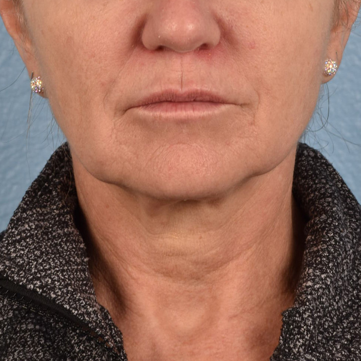 Facelift Before & After Gallery - Patient 315359 - Image 1