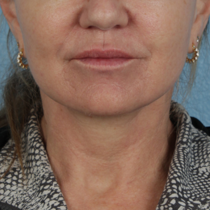 Facelift Before & After Gallery - Patient 315359 - Image 2