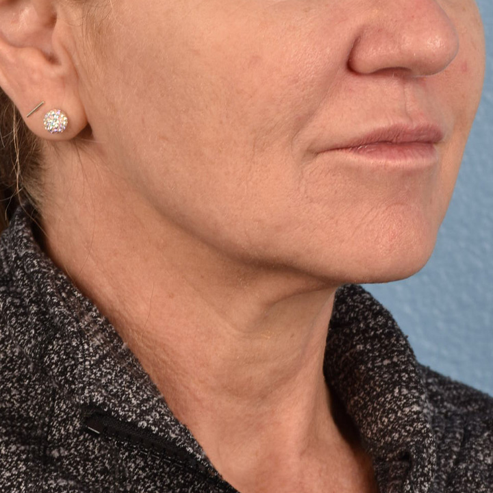 Facelift Before & After Gallery - Patient 315359 - Image 3