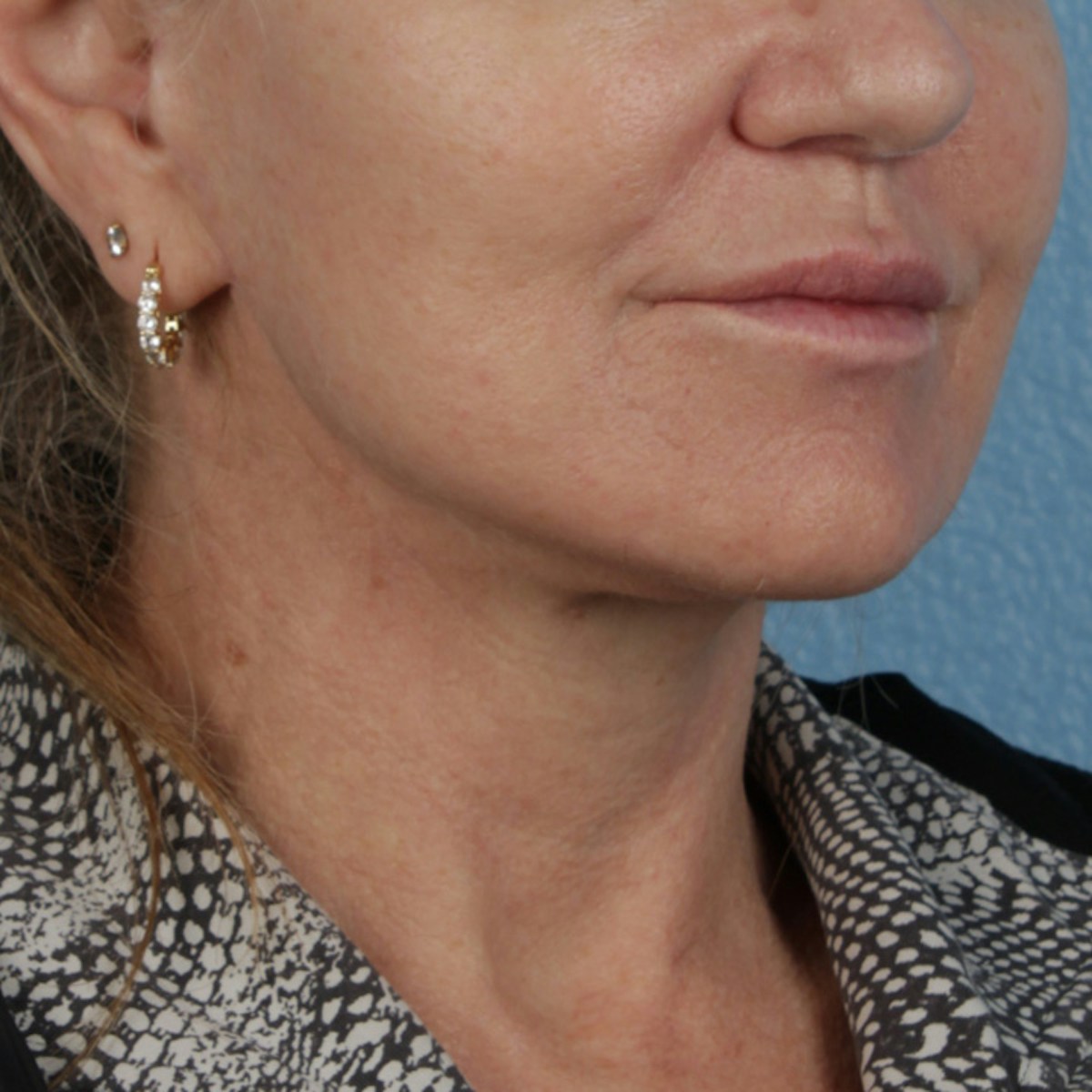 Facelift Before & After Gallery - Patient 315359 - Image 4