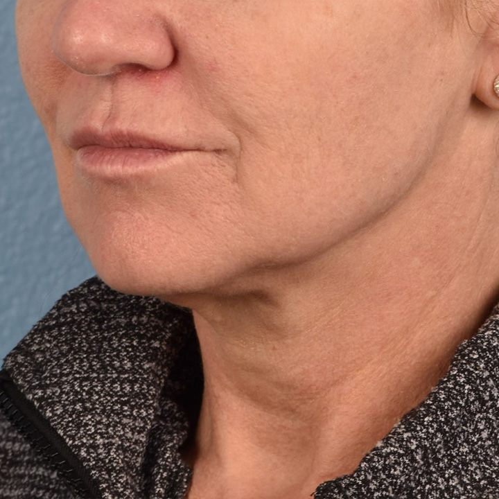 Facelift Before & After Gallery - Patient 315359 - Image 5