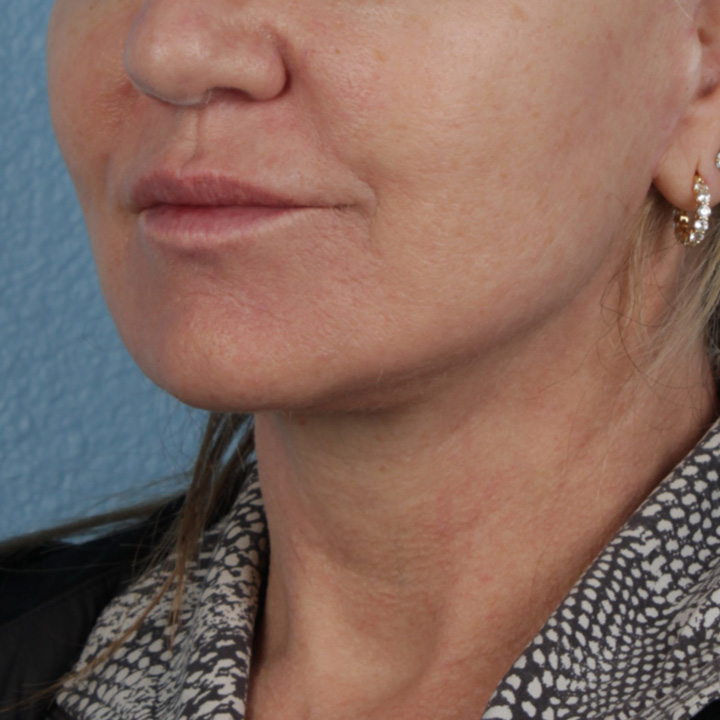 Facelift Before & After Gallery - Patient 315359 - Image 6