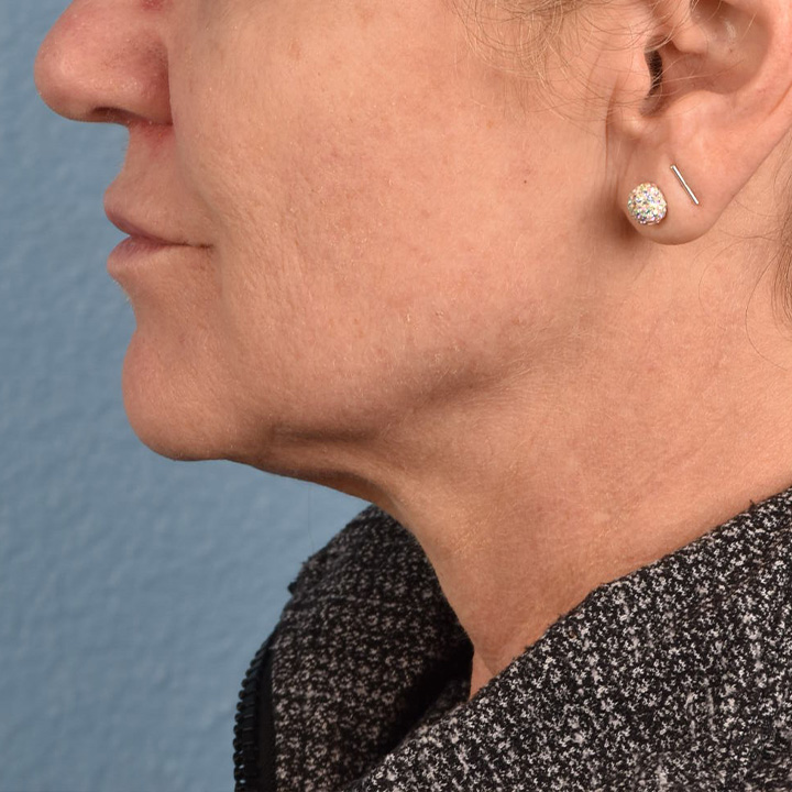 Facelift Before & After Gallery - Patient 315359 - Image 7