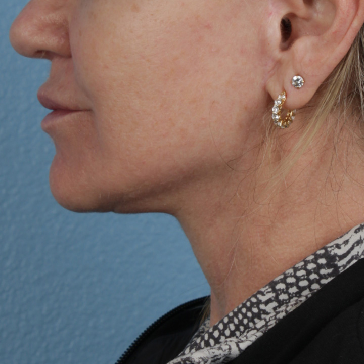 Facelift Before & After Gallery - Patient 315359 - Image 8