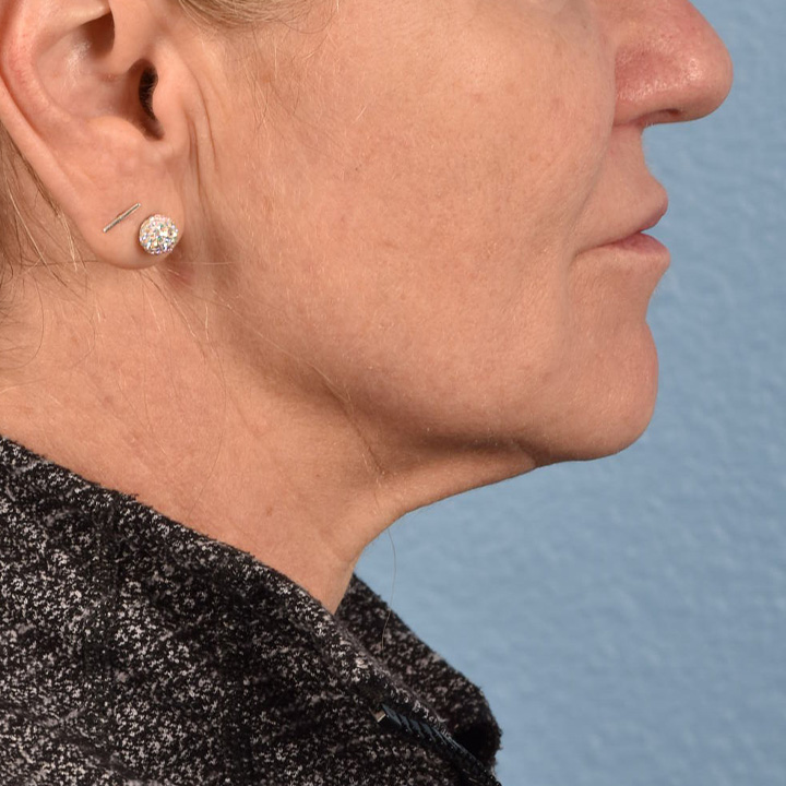 Facelift Before & After Gallery - Patient 315359 - Image 9