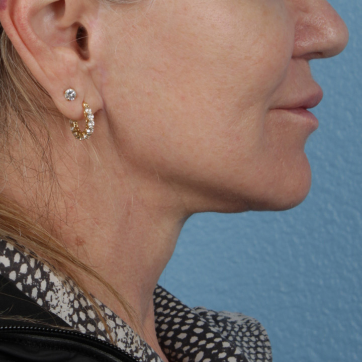Facelift Before & After Gallery - Patient 315359 - Image 10