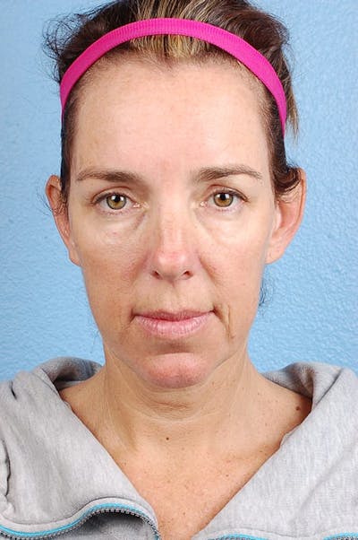 Mini Facelift Before & After Gallery - Patient 671591 - Image 1