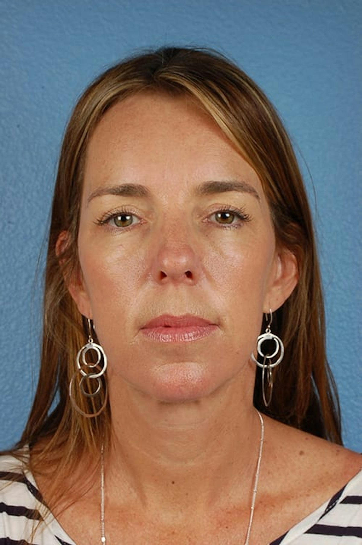 Mini Facelift Before & After Gallery - Patient 671591 - Image 2