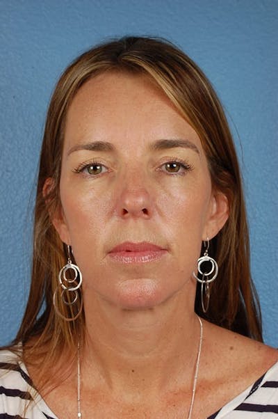Mini Facelift Before & After Gallery - Patient 671591 - Image 2