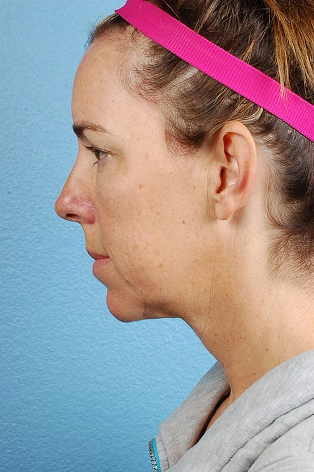 Mini Facelift Before & After Gallery - Patient 671591 - Image 3