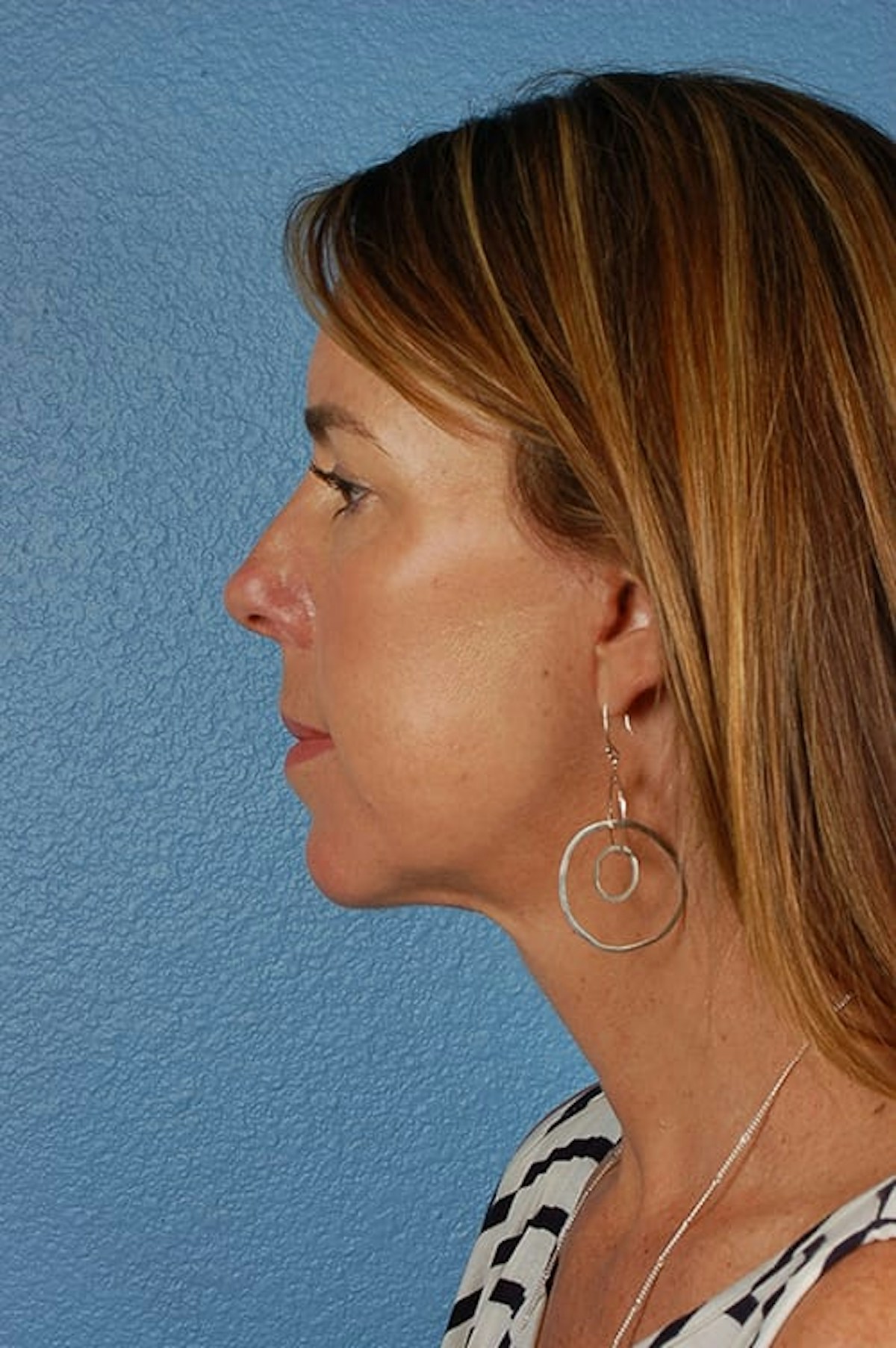 Mini Facelift Before & After Gallery - Patient 671591 - Image 4