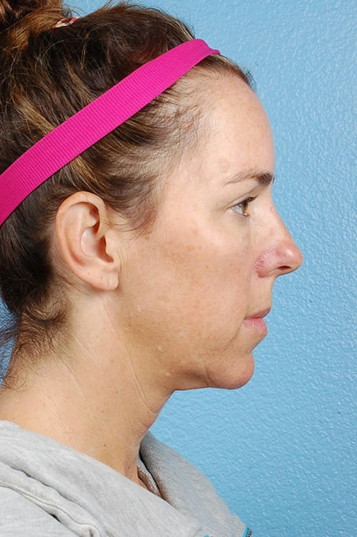 Mini Facelift Before & After Gallery - Patient 671591 - Image 5