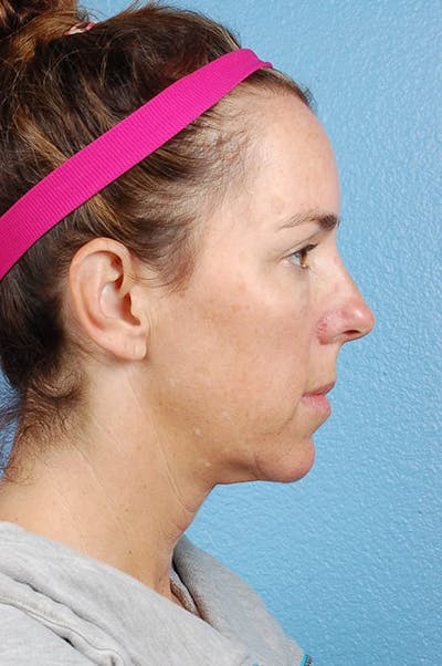 Mini Facelift Before & After Gallery - Patient 376741 - Image 1