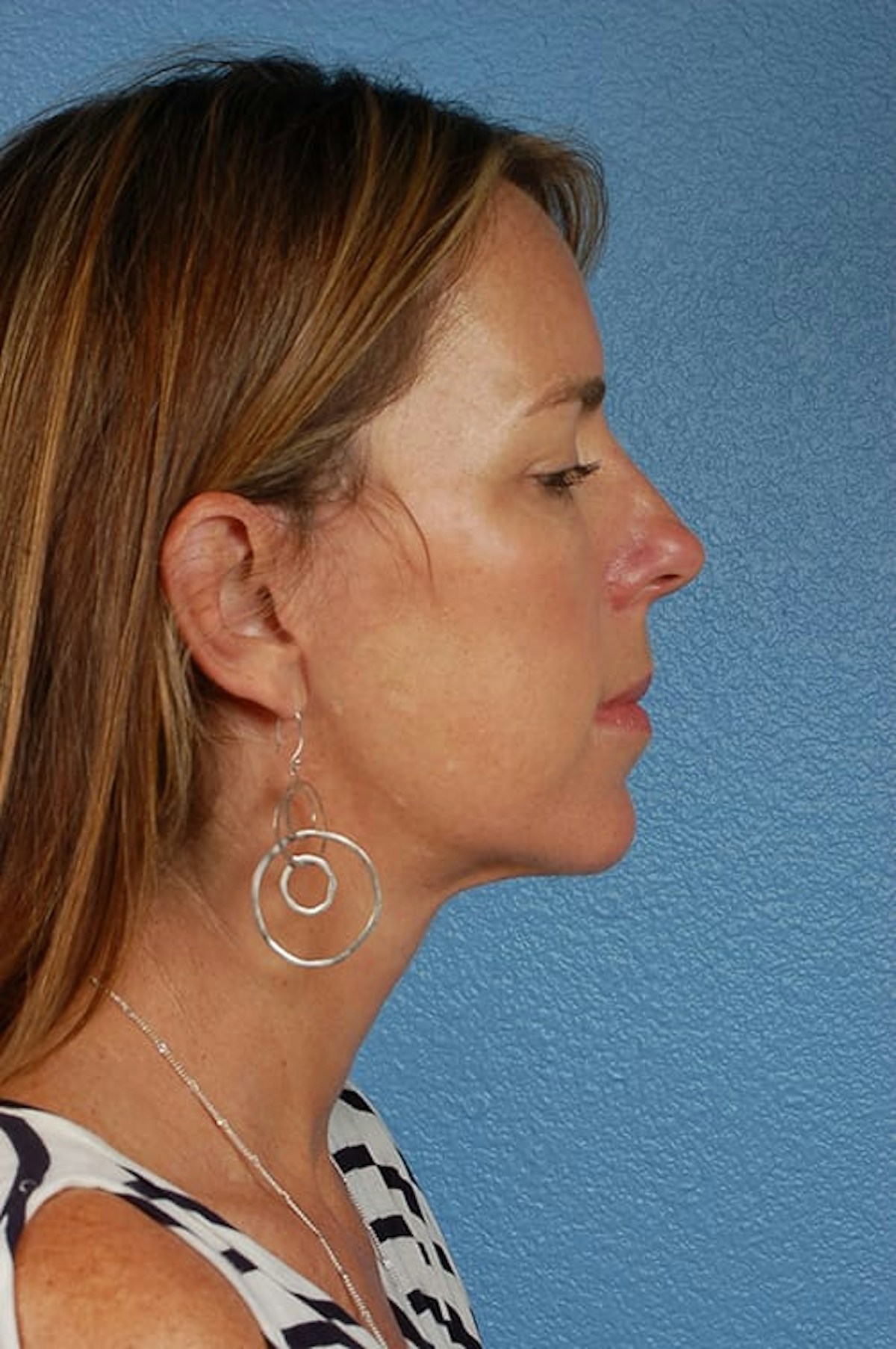 Mini Facelift Before & After Gallery - Patient 671591 - Image 6