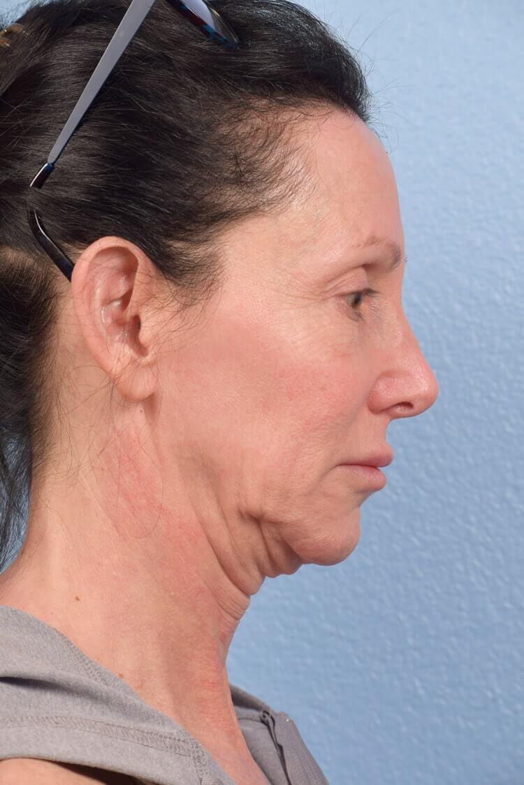 Mini Facelift Before & After Gallery - Patient 303846 - Image 1