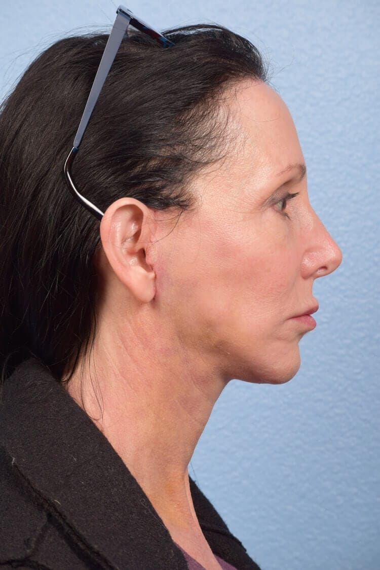 Mini Facelift Before & After Gallery - Patient 303846 - Image 2